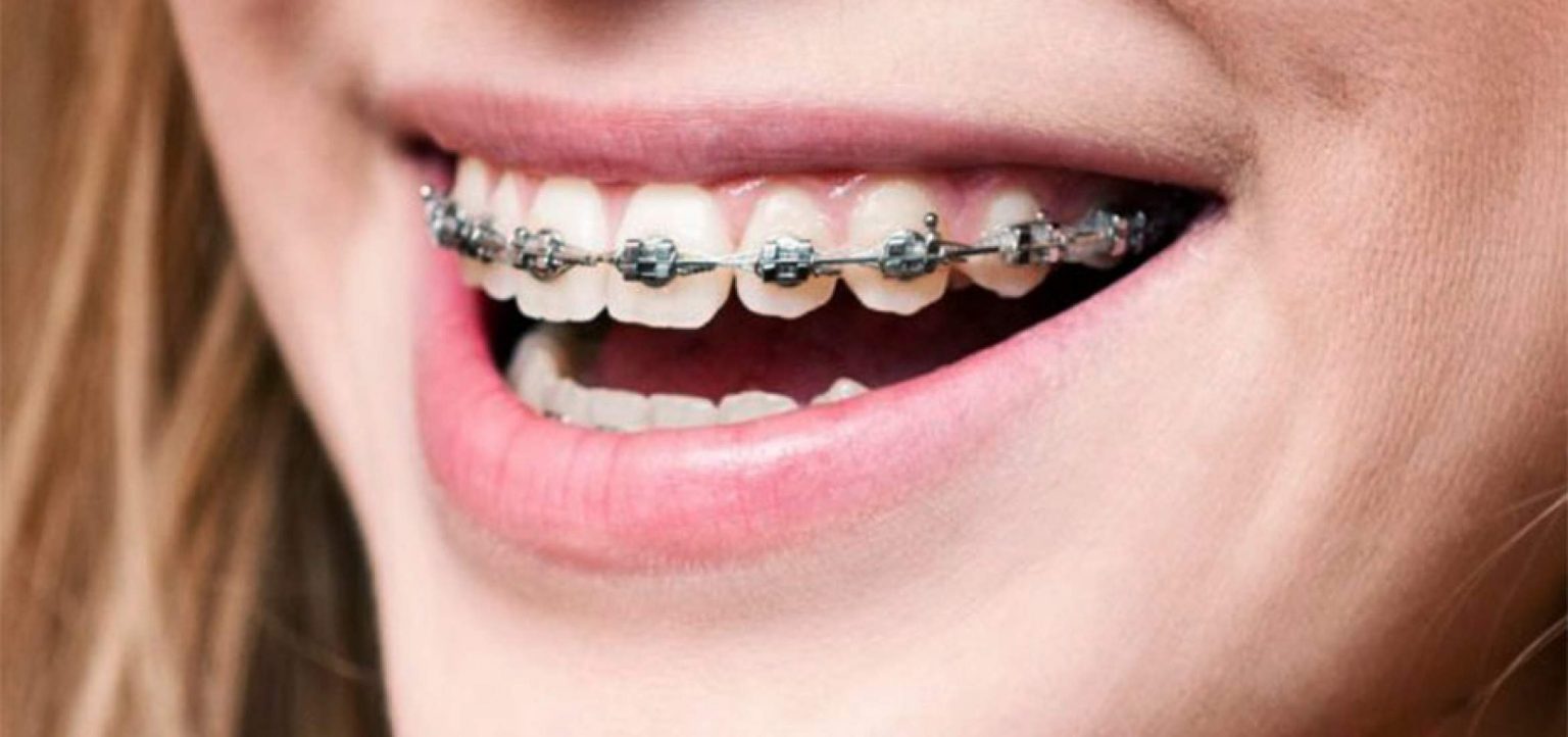 Fast Braces The Dental Lounge Robina